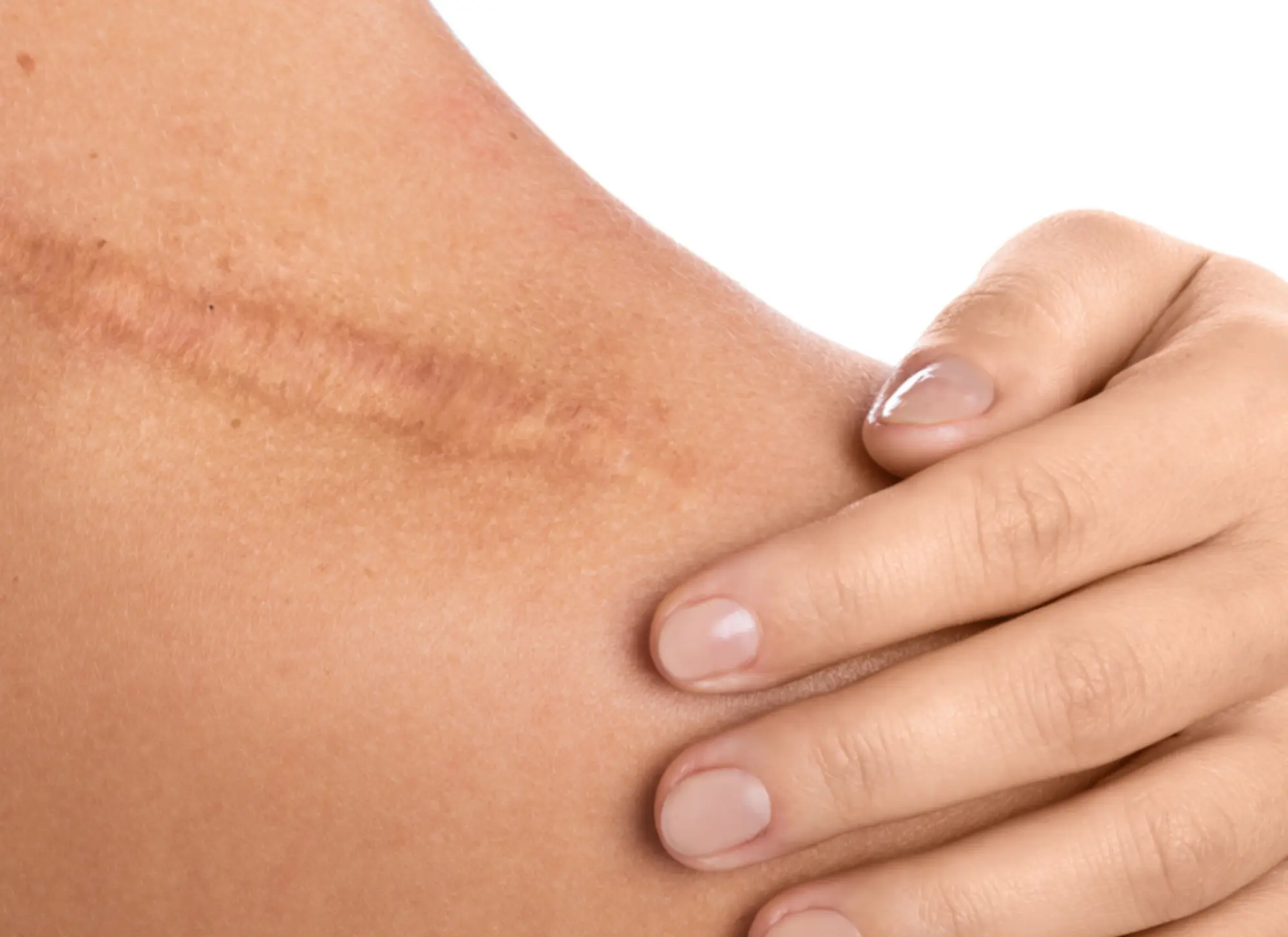 Vitavelle Cosmetics - Scar Hydrogel: Ihre Lösung für sichtbare Narbenreduktion